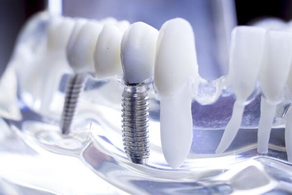 Dental Implants from Norwich Periodontal Associates